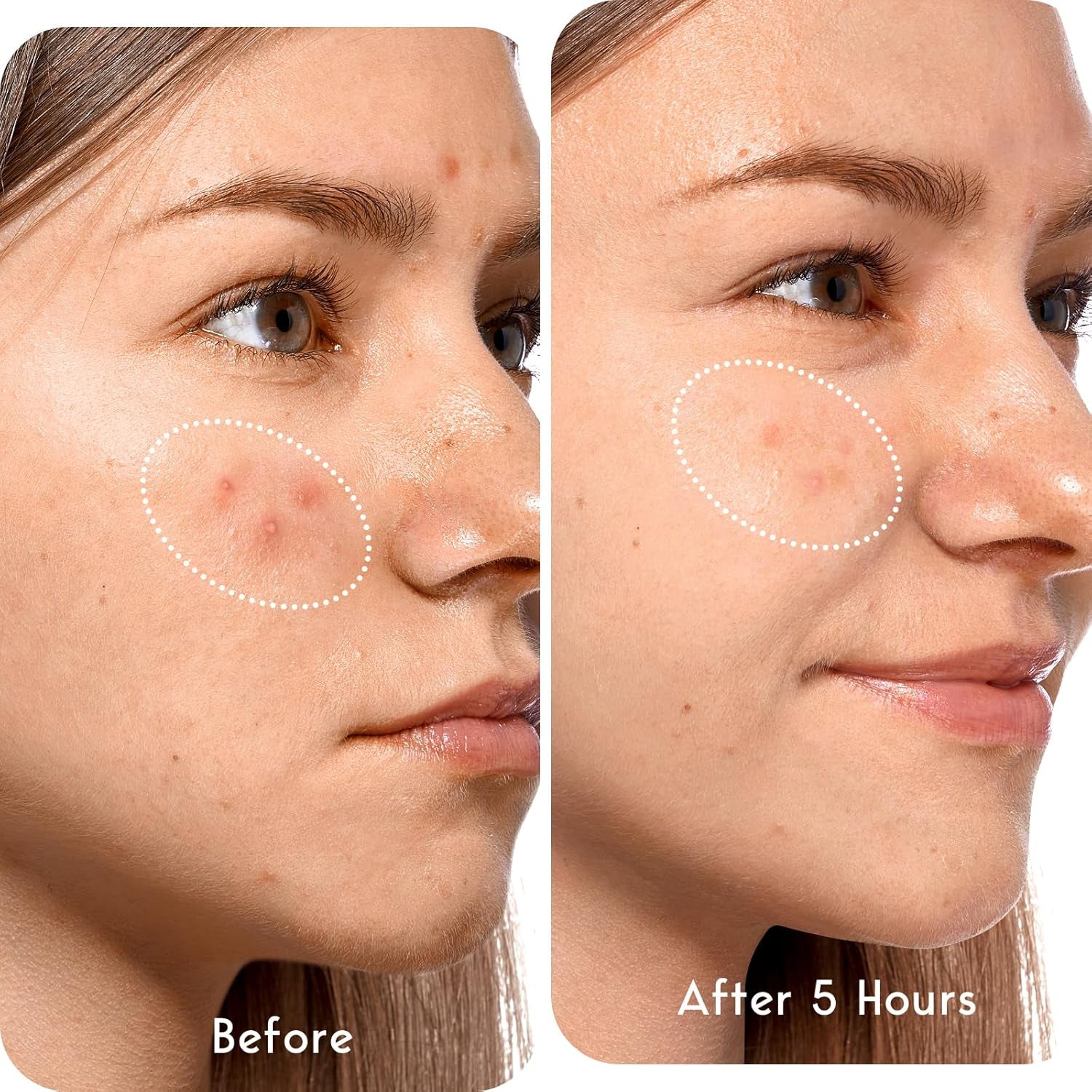 Acne Patches Large, Hydrocolloid Pimple Patches for Breakouts, Zit and Blemish, Acne Patches for Face, Chin, Back and Body with Tea Tree Oil