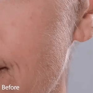 LED Facial Hair Remover & Exfoliator | Smooth, Radiant Skin